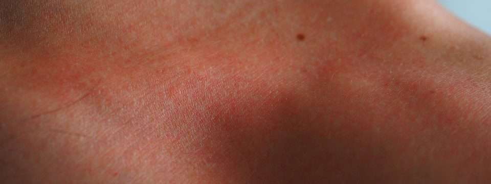 Do safety razors stop skin irritation?